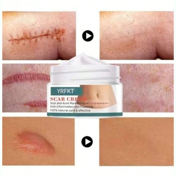 Cica_Cream_Creme_Para_Marcas_e_Cicatriz_-_Kaype_Store_Resultado_2_700x Melhores Produtos para Diminuir Marcas e Cicatrizes 2025
