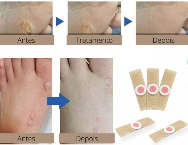 Remover-Verrugas-e1741129610927 Como Remover Verruga em Casa e Sem Dor: Métodos Eficazes e Produtos Recomendados 2025