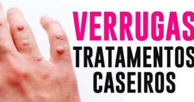 Remover verruga em casa