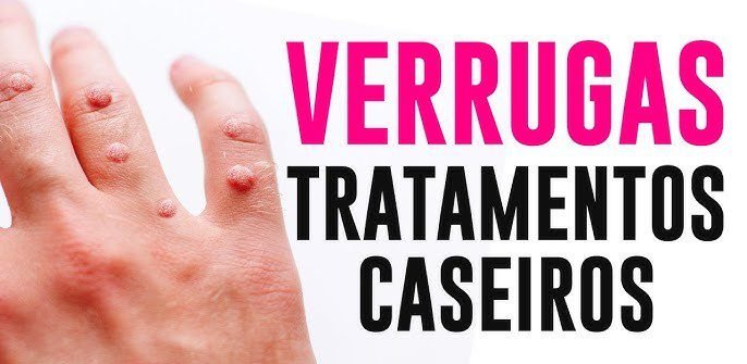 Remover verruga em casa