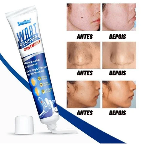 como-remover-verruga-em-casa-sem-dor-Wart Como Remover Verruga em Casa e Sem Dor: Métodos Eficazes e Produtos Recomendados 2025