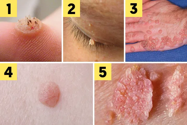 como-remover-verruga-em-casa-sem-dor Como Remover Verruga em Casa e Sem Dor: Métodos Eficazes e Produtos Recomendados 2025
