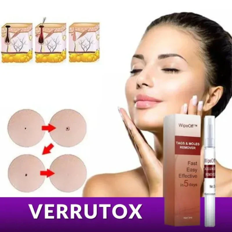 verrutox-wipe-off-removedor-profissional-de-marcas-manchas-e-verrugas-kaypestore-1-verrutox-401683_800x_8dbdf9ca-a3bf-4c7e-bba4-441b0bfdbc6f_800x Como Remover Verruga em Casa e Sem Dor: Métodos Eficazes e Produtos Recomendados 2025