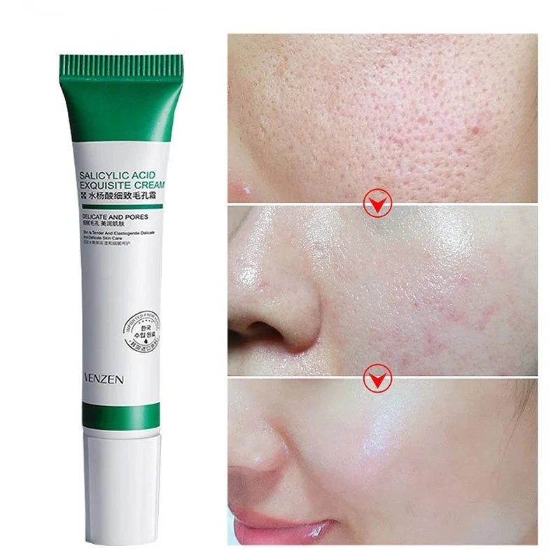 creme-para-remocao-de-poros-e-clareamento-de-manchas-kaypestore-340459 Como Diminuir os Poros – Métodos Eficazes 2025