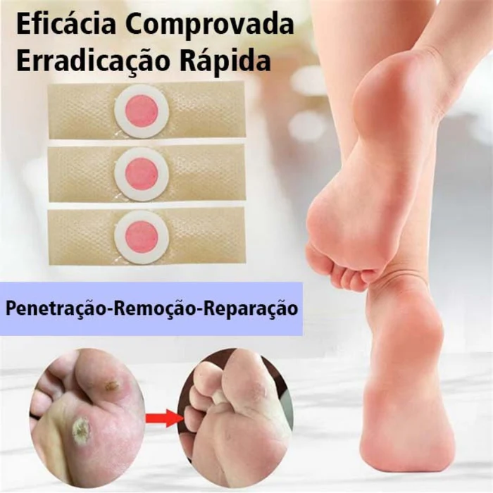 Adesivos_Removedor_De_Calos_Verrugas_Olho_De_Peixe_Original_-_Kaype_Store_2 Tratamento para Calos e Olho de Peixe: Soluções Eficazes para Pés Saudáveis 2025
