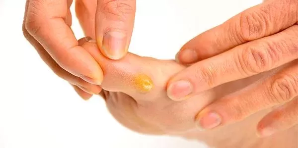 Calo-olho-de-peixe-pes-rachados-2 Tratamento para Calos e Olho de Peixe: Soluções Eficazes para Pés Saudáveis 2025