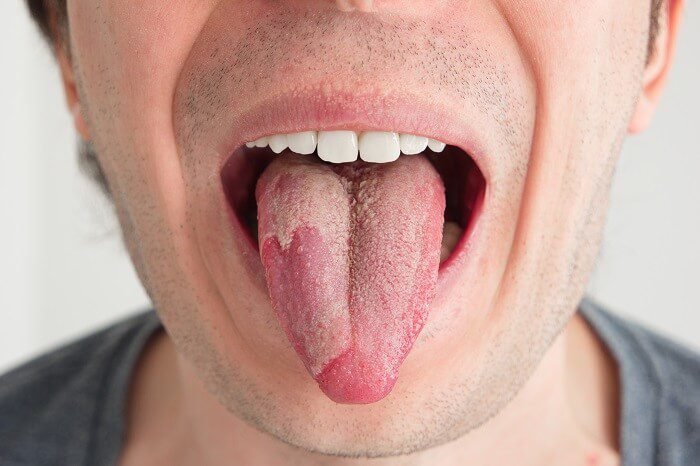 Candidiase-oral-tratamento Candidíase: Sintomas, Tratamentos e Como Prevenir (Guia Completo) 2025