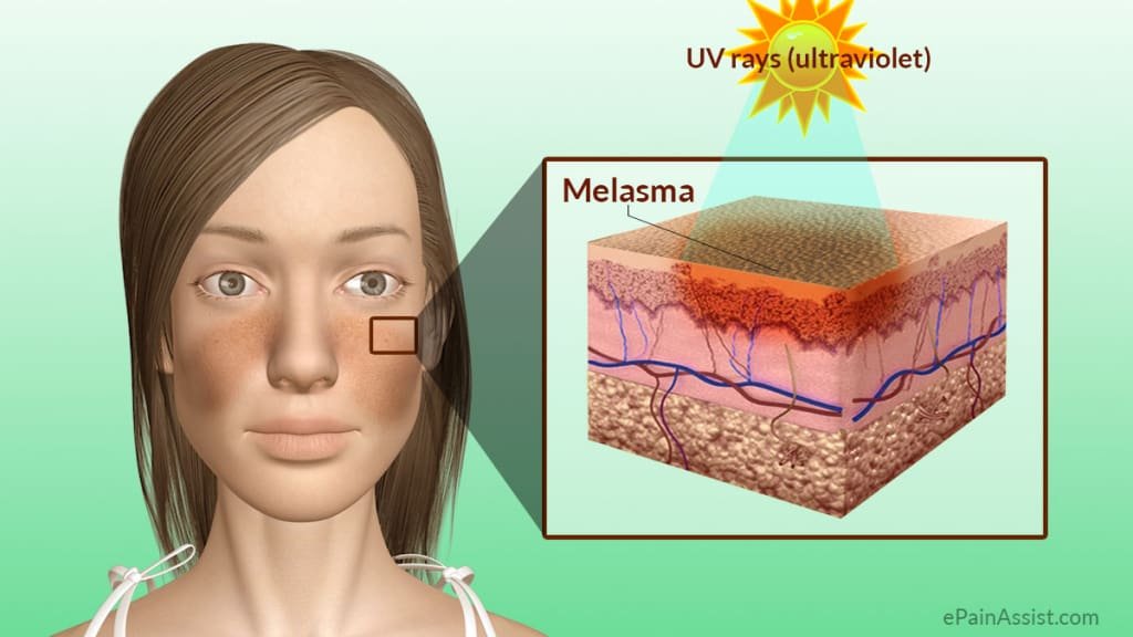Tratamento-para-Melasma-3 Tratamento para Melasma 2025
