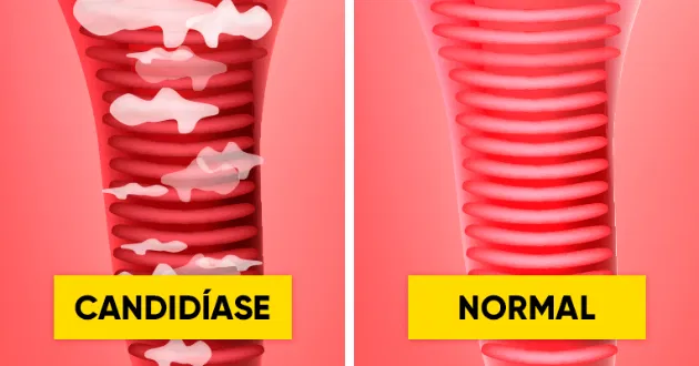 candidiasevaginal Candidíase: Sintomas, Tratamentos e Como Prevenir (Guia Completo) 2025