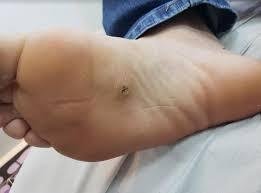 olho-de-peixe-1 Tratamento para Calos e Olho de Peixe: Soluções Eficazes para Pés Saudáveis 2025