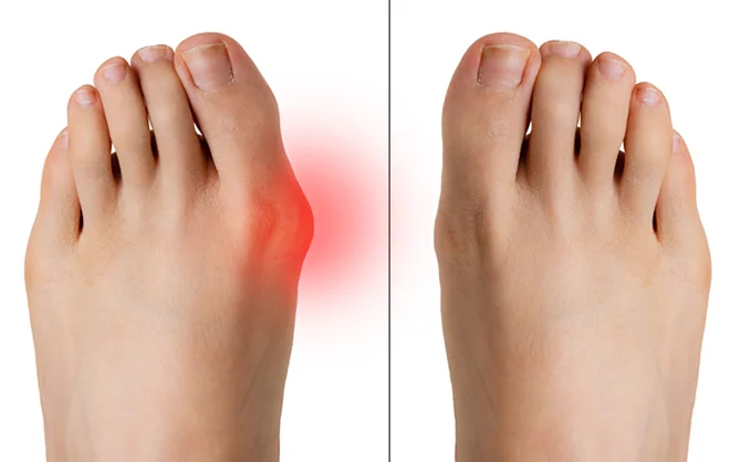 Joanete-Imperio Joanete: O que é, causas e como tratar sem cirurgia 2025