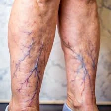 images 10 Hábitos que Pioram Suas Varizes (e Como Evitar) - Guia Completo 2025