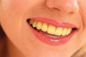 Dentes-Amarelados Como Clarear os Dentes de Forma Segura e Rápida 2025