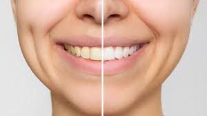 clareamento-dental Clareamento Dental em Casa: Como o Sérum V34 Pode Ajudar