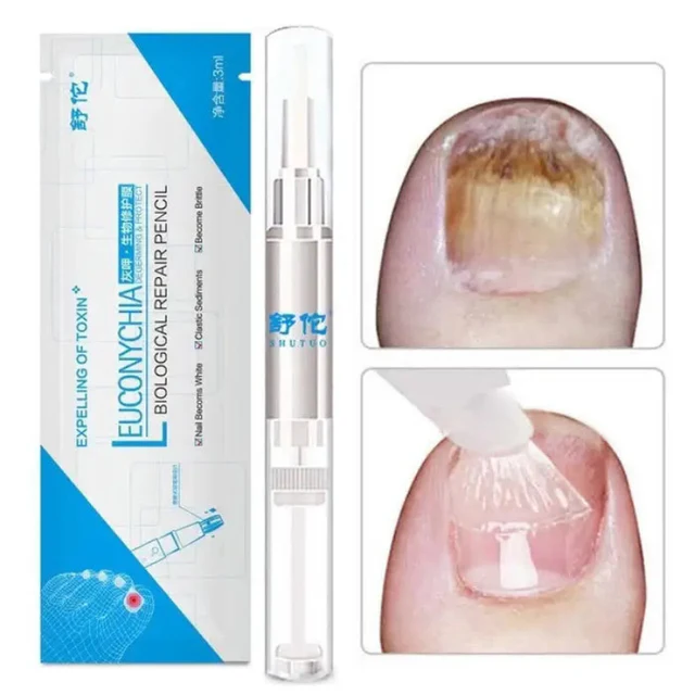 Fungo_Pen_Caneta_Estetica_para_Cuidados_com_as_Unhas_Kaype_Store-4 Como Tratar Fungo na Unha: Guia Completo para Eliminar Micose 2025