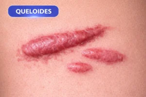 Por-que-Estrias-e-Cicatrizes-se-Formam-Causas-Tipos-e-Tratamentos-Eficazes-1-300x200 Por que Estrias e Cicatrizes se Formam? Causas, Tipos e Tratamentos Eficazes 2026