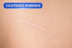 Por-que-Estrias-e-Cicatrizes-se-Formam-Causas-Tipos-e-Tratamentos-Eficazes-2-300x200 Por que Estrias e Cicatrizes se Formam? Causas, Tipos e Tratamentos Eficazes 2026