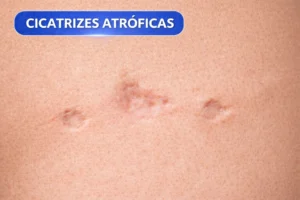 Por-que-Estrias-e-Cicatrizes-se-Formam-Causas-Tipos-e-Tratamentos-Eficazes-3-300x200 Por que Estrias e Cicatrizes se Formam? Causas, Tipos e Tratamentos Eficazes 2026
