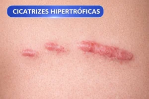 Por-que-Estrias-e-Cicatrizes-se-Formam-Causas-Tipos-e-Tratamentos-Eficazes-4-300x200 Por que Estrias e Cicatrizes se Formam? Causas, Tipos e Tratamentos Eficazes 2026
