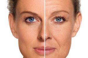 acido-hialuronico-300x200 Ácido Hialurônico na Pele: O que é, Como Funciona e Por que Está em Alta no Tratamento de Cicatrizes e Estrias