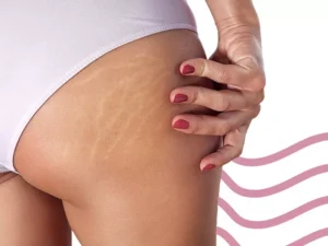 estrias-branca-300x225 Por que Estrias e Cicatrizes se Formam? Causas, Tipos e Tratamentos Eficazes 2026