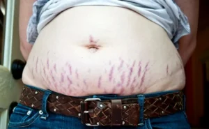 estrias-vermelhas-300x185 Por que Estrias e Cicatrizes se Formam? Causas, Tipos e Tratamentos Eficazes 2026