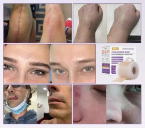 fita-microagulhas-acido-hialuronico-kaype-store_5_480x480-300x264 Por que Estrias e Cicatrizes se Formam? Causas, Tipos e Tratamentos Eficazes 2026