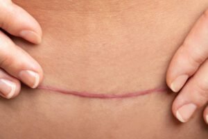 Cicatrizes-1-300x200 Como Tratar Cicatrizes Sem Procedimentos Invasivos: Guia Completo 2026