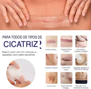 fita-reparadora-de-cicatriz-300x294 Como Tratar Cicatrizes Sem Procedimentos Invasivos: Guia Completo 2026