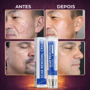 Creme-Cicatrizante-para-Acne-4-300x300 Como Tirar Cicatriz de Espinha: Dicas e Tratamentos Eficazes 2026