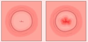 ectopia-cervical-nova-300x144 O que o HPV Pode Causar na Mulher: Compreendendo os Riscos e Como se Proteger 2026